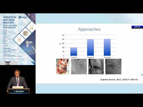 J. Velianou | Results of valve-in-MAC (mitral annular calcification) procedures.