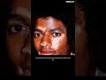 The Truth About Michael Jackson's Skin: Understanding Vitiligo
