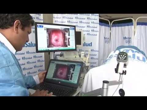 Sobre el cáncer cervical