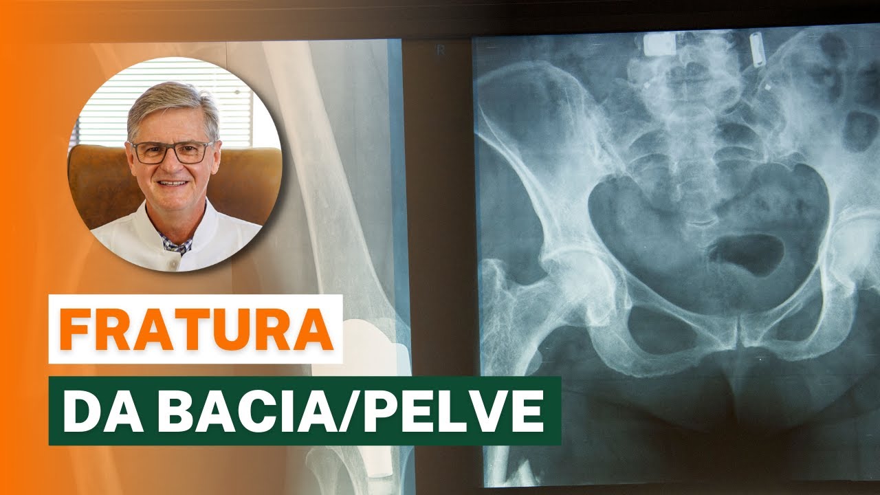 Fratura na Bacia/Pelve - O Que Fazer? (Sintomas, Diagnóstico e Tratamento)