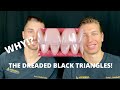 BLACK TRIANGLES BETWEEN TEETH! WHY??