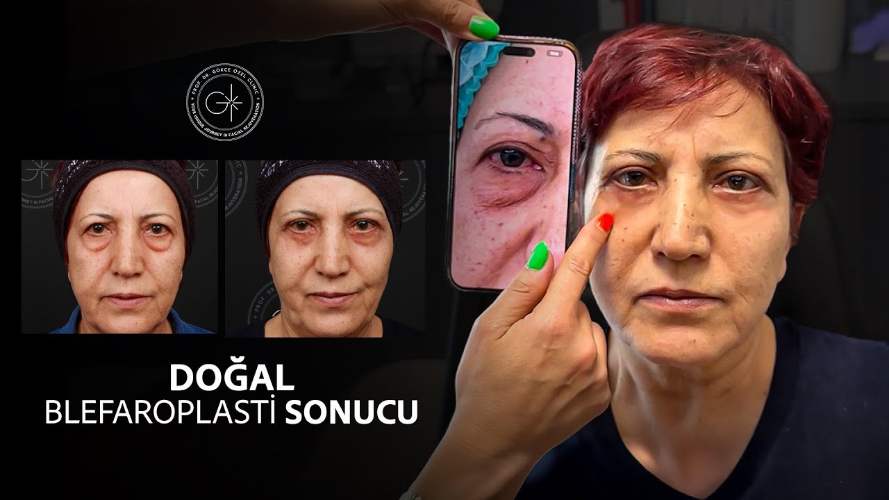 DOĞALLIKTAN VAZGEÇMEDEN YENİLENME! #gözkapağıestetiği #gözkapağıameliyatı #gözkapağıdüşüklüğü