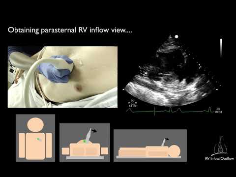 05. Right ventricular inflow & outflow views