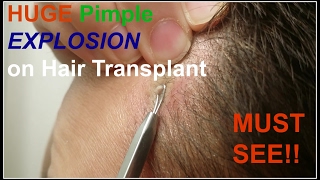 How to Pop A Pimple After Hair Transplant!!
