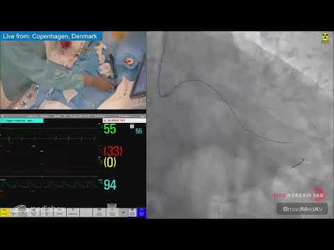 PCI of LCX CTO Using Antegrade Approach