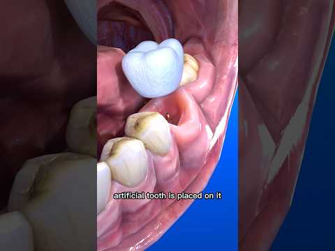 The Science Behind Dental Implants