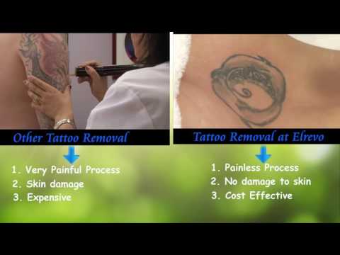 Tattoo Removal at elrevo clinic