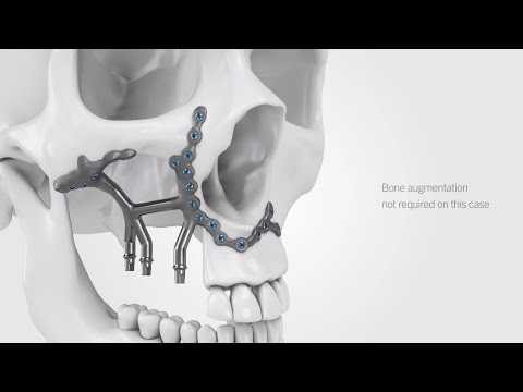 IPS Implants® Preprosthetic | Treatment workflow