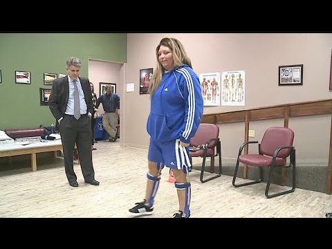 Ladies In Leg Braces