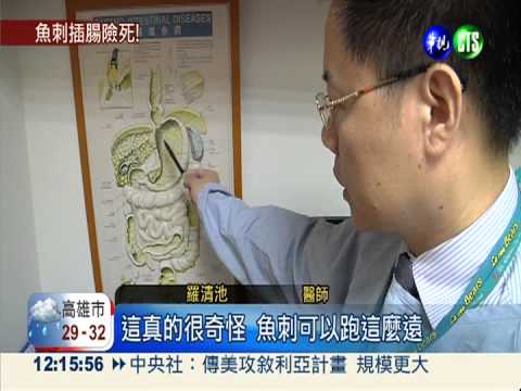 誤食魚刺狂吞飯 婦腹膜炎險沒命!