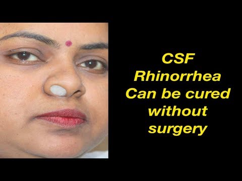 Case of CSF Rhinorrhea Cured