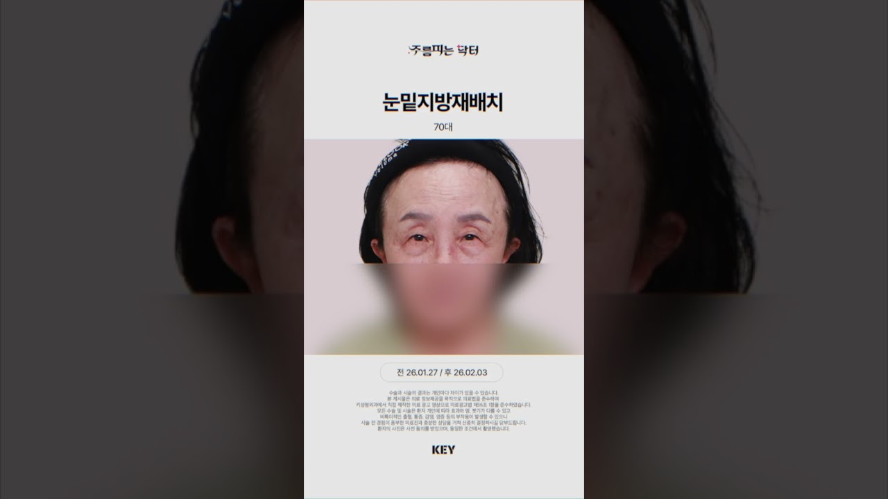 70대의 눈밑지방재배치