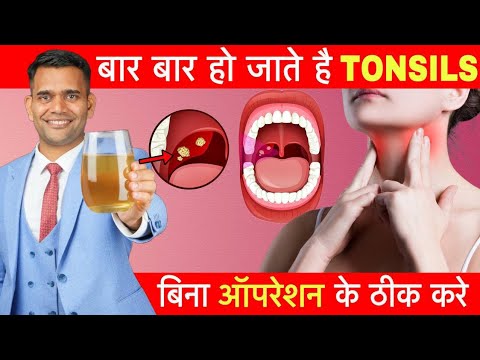 बिना Operation के Tonsils घर में ठीक करें | Tonsillitis Home Remedies
