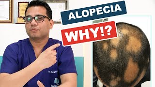 What is Alopecia areata ?- Causes, Diagnosis &amp; Hair Re-growth Treatments? @SkinQure (in Hindi)