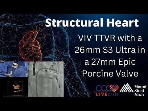 VIV TTVR with a 26mm S3 Ultra in a 27mm Epic Porcine Valve