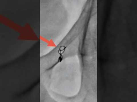 Varicocele embolization live case - Step 9 #nosurgery  | Dr. Gaurav Gangwani