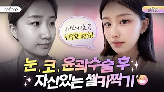 붓기 빠지고 나서, 진짜 제 얼굴이 보여요 ㅣ 눈, 코, 윤곽 후기