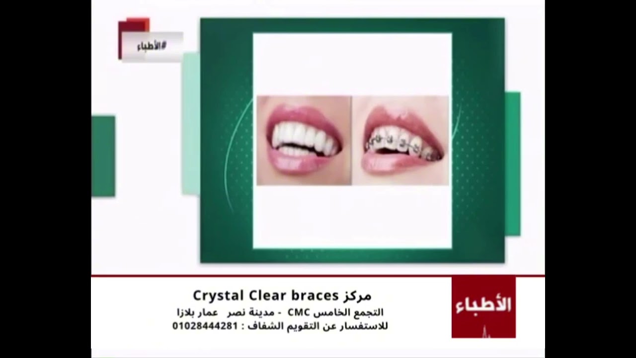 فترة العلاج بالتقويم الشفاف