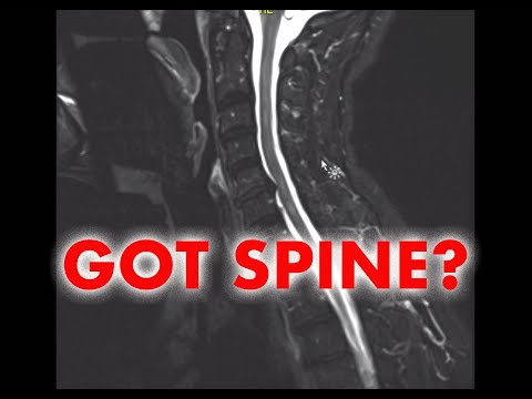 Understand Your Scan: Multiple Sclerosis MRI Cervical Spine