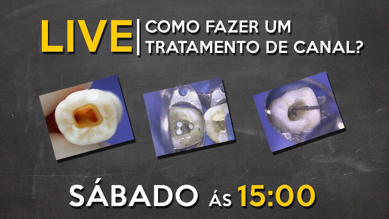 LIVE #009 - Como fazer um tratamento endodôntico?