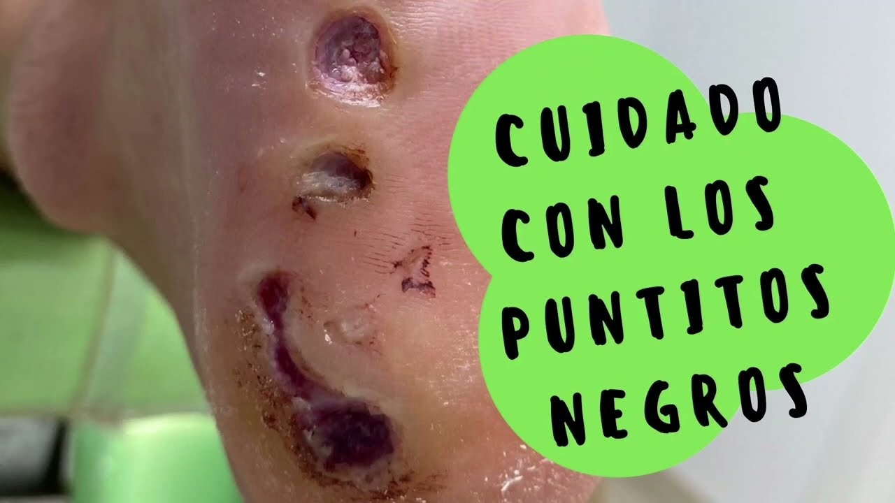 Cirugía de Papiloma o verruga plantar (Testimonio)