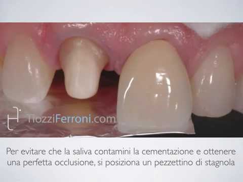 Cementazione Adesiva