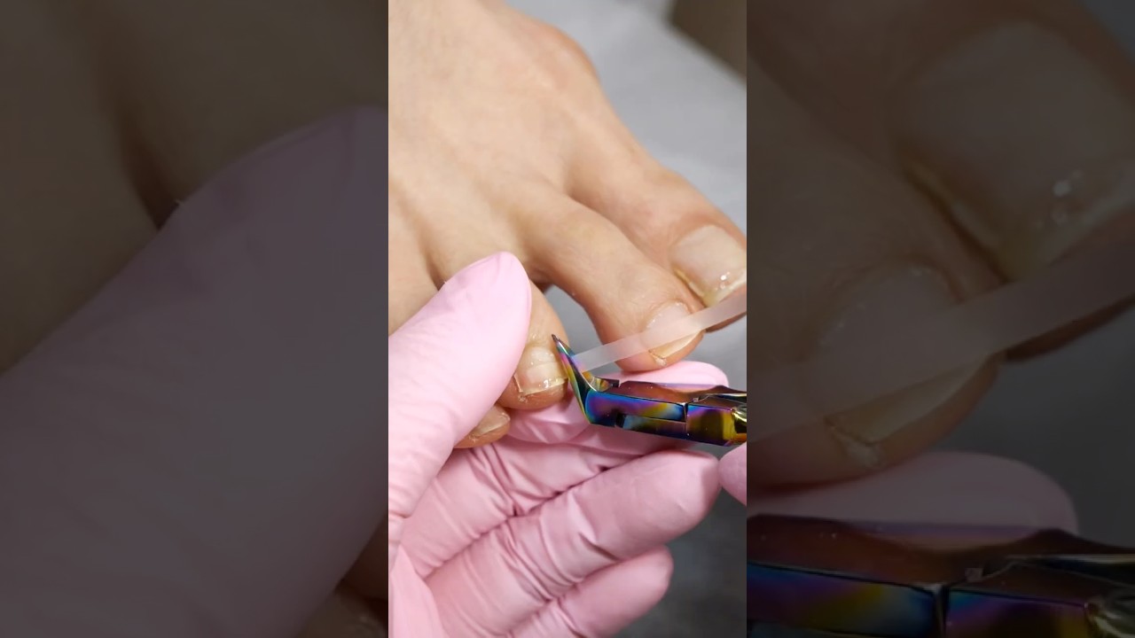 巻き爪ケアフレックスプレート症例/足の第三趾（だいさんし）