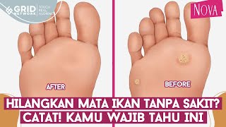 Download lagu 3 Cara Menghilangkan Mata Ikan di Telapak Kaki || Kaki Jadi Mulus Lagi Deh! mp3 Download lagu 3 Cara Menghilangkan Mata Ikan di Telapak Kaki || Kaki Jadi Mulus Lagi Deh! mp3