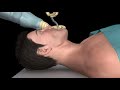 Oral Airway Insertion