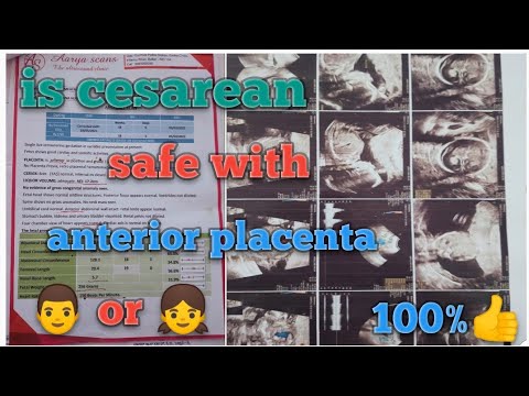 is c-section delivery safe with anterior placenta ||👨 or 👧