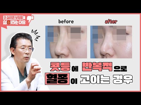 #실리콘코성형 후 갑자기 콧등이 붓고 멍이 드는 이유는?