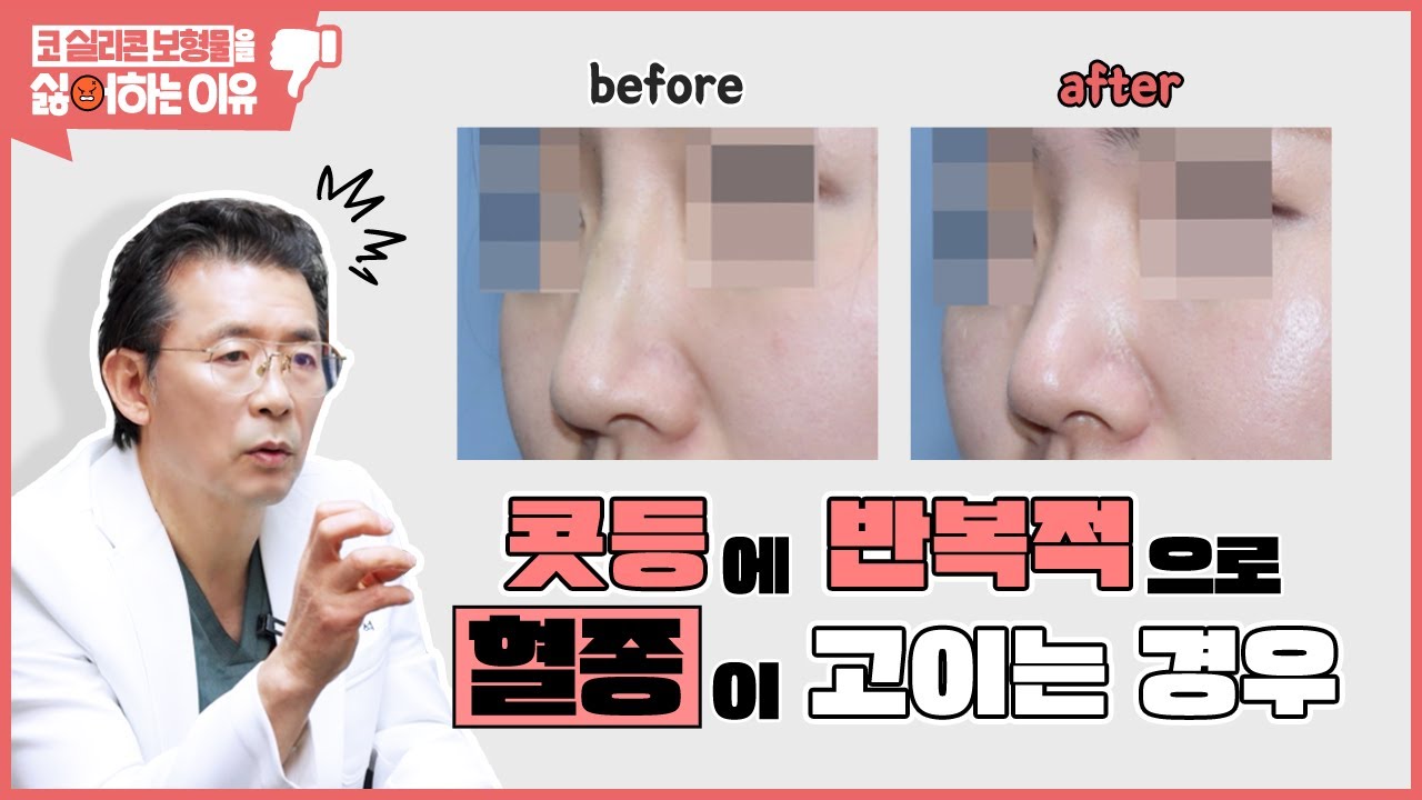 #실리콘코성형 후 갑자기 콧등이 붓고 멍이 드는 이유는? 썸네일