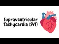 Supraventricular Tachycardia (SVT)