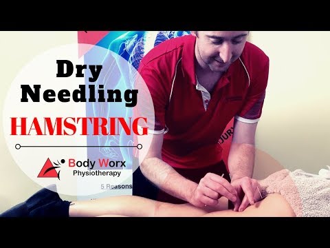 乾針處理腿後肌肌腱疼痛 - Jason Bradley BodyWorx 物理治療 (Dry Needling Hamstring - Jason Bradley BodyWorx Physio)