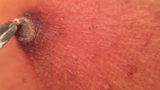 PART 2- Dilated Pore scab - Full extraction