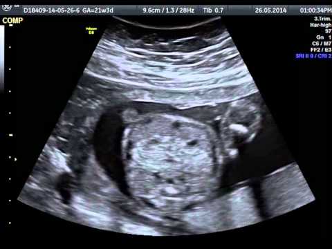Displasia dellanca in 2 mesi Sostituzione dellanca 3 gradi