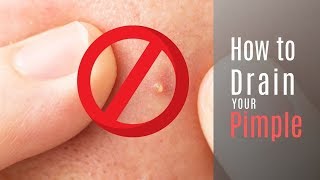 How to Drain Your Pimple to Get Rid of a Popped Pimple Redness!