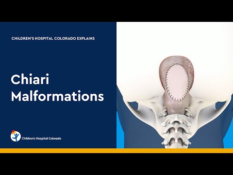 Chiari Malformation and Treatment