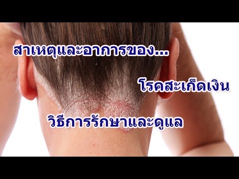 สิ่งที่ประเภทมีกลาก ครีมสำหรับสะเก็ดกลากหลัง