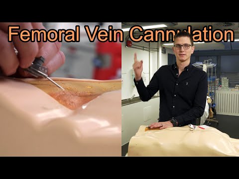 How to Cannulate the Femoral Vein Step by Step Guide for Emergency & Critical Care Providers