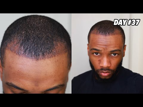 Day 37 After My Hair Transplant