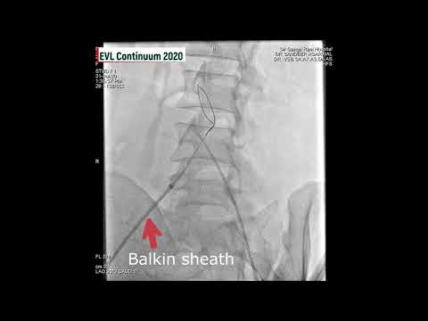 Uterine artery embolization hardware mishap managed successfully...Endovascular Live...