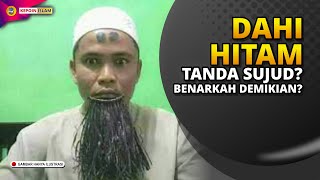 Download lagu Dahi Hitam Tanda Sujud? Benarkah demikian? mp3 Download lagu Dahi Hitam Tanda Sujud? Benarkah demikian? mp3