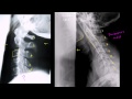 Adequacy of the Lateral Cervical Spine X-Ray Video Tutorial