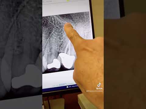 Root canal therapy of tooth #13. Calcified!