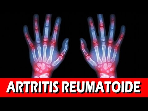 Remedios caseros para la artritis reumatoide