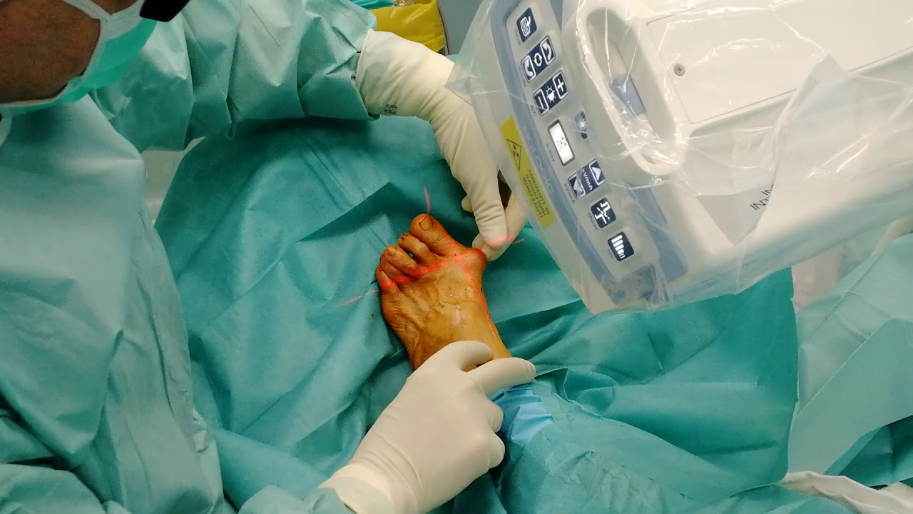 Alluce valgo con igroma e 2°3° dito a martello piede sinistro