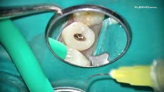 POV clinical video of RCT of tooth 13 from start to finish. Go to flexivodental.com @FlexivoDental