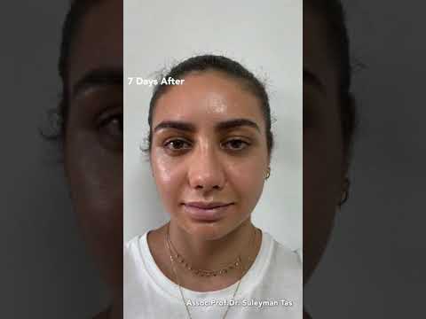 Celebrity Nose | Closed Atraumatic Rhinoplasty