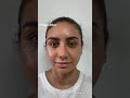 Celebrity Nose Closed Atraumatic Rhinoplasty